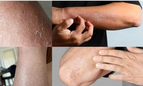 Ngứa kéo dài ở đâu và đi kèm dấu hiệu gì thì nên đi khám?