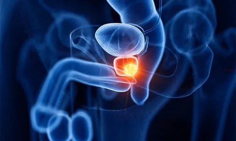 Gia đình có 4 người cùng mắc một loại ung thư, bác sĩ cảnh báo: "Đừng để sự chủ quan biến thành bản án tử hình"