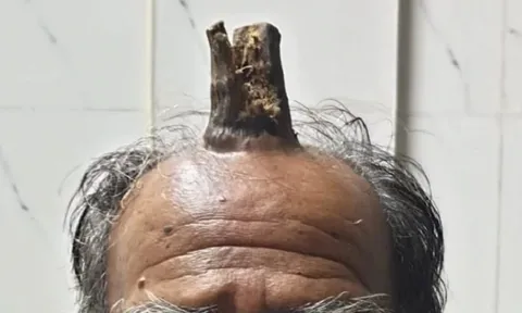 Người đàn ông bất ngờ mọc "sừng" trên đỉnh đầu, thợ hớt tóc càng gọt càng mọc dài, bác sĩ tiết lộ nguyên nhân cực sốc