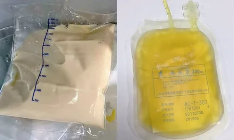 Ăn đồ chiên, uống trà sữa suốt một năm, cô gái 27 tuổi nhập viện khẩn cấp, bác sĩ lắc đầu
