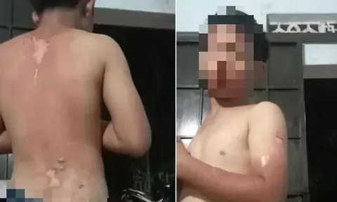Xót xa bé trai ở Đắk Lắk với nhiều vết phồng rộp trên lưng nghi bị mẹ tạt nước sôi: Công an thông tin kết quả xác minh ban đầu