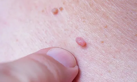 Trẻ 10 tuổi đi bơi về, lòng bàn chân mọc đầy nốt nhỏ: Phát hiện nhiễm HPV, cảnh báo sai lầm nhiều phụ huynh mắc phải
