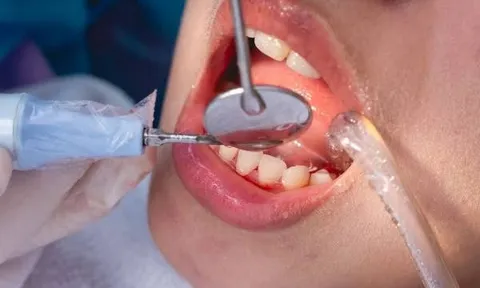 Lấy cao răng tưởng đơn giản, nhưng có trường hợp được BHYT chi trả: Ai thuộc diện này?