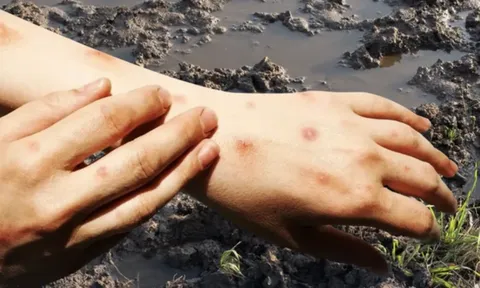 Báo động khẩn: Bệnh sốt đất bùng phát tại Thái Lan làm 23 người tử vong