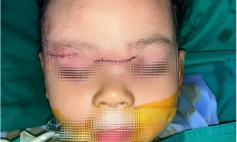Bé gái 22 tháng tuổi bị chó cắn tổn thương nặng, hiện ra sao?