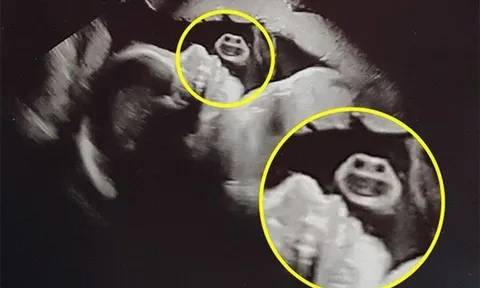 Bức ảnh siêu âm phát hiện một “gương mặt” xuất hiện bên cạnh thai nhi khiến bác sĩ bật cười, mẹ bầu ngơ ngác