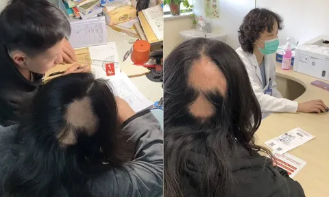 Thức đêm kèm con học, người mẹ không ngờ mình lại bị rụng tóc đến mức hói cả mảng lớn, sức khỏe suy kiệt