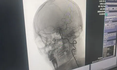 Tưởng xoa bóp vai gáy càng mạnh càng hiệu quả, người đàn ông 33 tuổi bất ngờ bị đột quỵ và liệt nửa người