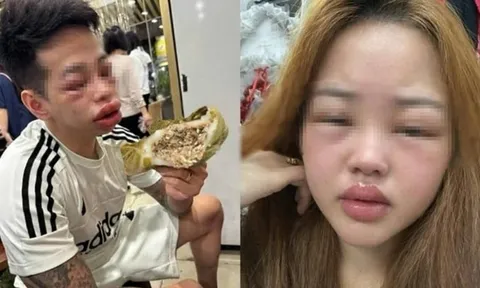 Mặt sưng vù, mắt híp tịt sau khi "đu trend" ăn bánh trứng kiến: Bác sĩ cảnh báo điều này