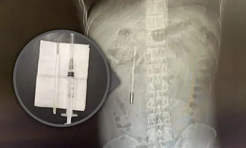 Người đàn ông đi khám mới bàng hoàng phát hiện dị vật mang trong người suốt 20 năm