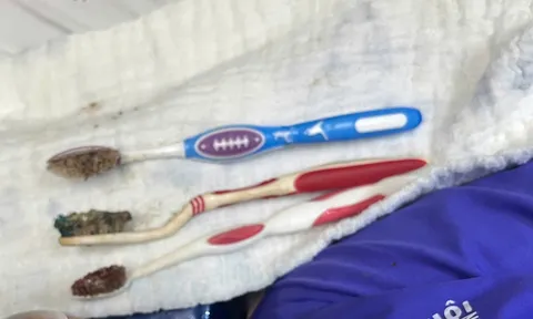 Bất ngờ với lý do nam thanh niên tự nuốt 3 bàn chải đánh răng vào bụng, bác sĩ nhắc nhở điều này