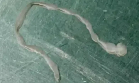 Nghĩ là u não, người phụ nữ đi khám mới bàng hoàng khi bác sĩ lấy ra "sinh vật lạ" trong đầu