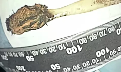 Nuốt bàn chải từ năm 12 tuổi, người đàn ông đi khám mới biết vẫn nằm trong bụng suốt 52 năm