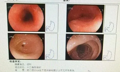 Ăn lẩu quá nóng rồi uống nước đá cho dịu, người phụ nữ không ngờ thực quản đã bị loét nghiêm trọng