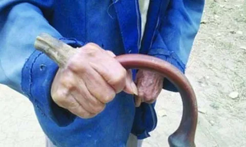 Cụ ông 98 tuổi phải sống chung với "chiếc sừng" kỳ lạ dài tới 10 cm suốt gần 10 năm trời