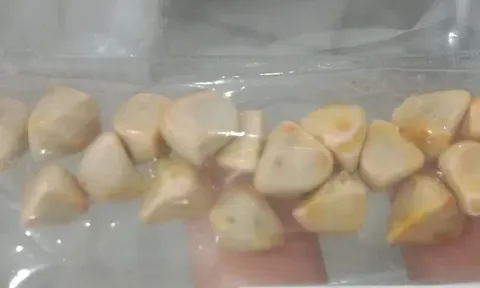 Ngày nào cũng uống trà đá, người phụ nữ đi khám mới bàng hoàng phát hiện cả "ổ" sỏi trong cơ thể: Bác sĩ cảnh báo điều này