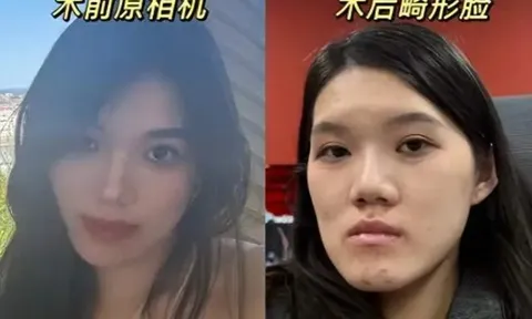 Từ móm nhẹ thành mặt "lưỡi cày" sau ca phẫu thuật thẩm mỹ, cô gái "khóc thét" trước lời giải thích của bác sĩ