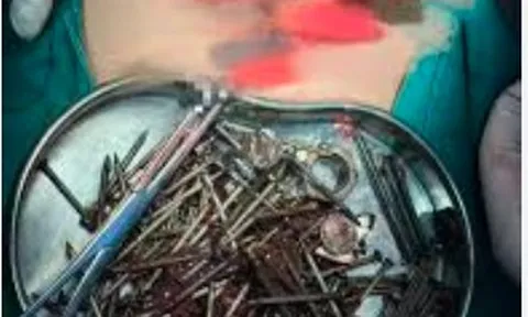Đau bụng, nôn mửa liên tục, người đàn ông đi khám rồi tá hỏa khi thấy 180 "vật thể lạ" nhọn hoắt trong dạ dày: Bác sĩ cảnh báo điều này
