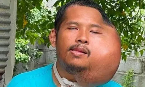 Người đàn ông có khuôn mặt biến dạng đến khó tin chỉ vì một thói quen mà nhiều người vẫn làm mỗi ngày