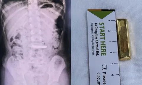 Bé gái 5 tuổi nuốt thỏi vàng dài 4 cm, bác sĩ phải kích hoạt "kênh xanh" khẩn cấp