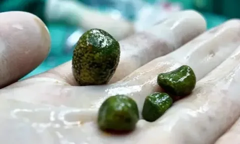 Tưởng bốn vật thể màu xanh là những viên đá quý, sự thật bên trong cơ thể cô gái lại khiến nhiều người “nổi da gà”