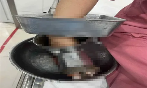 Dùng tay đưa thịt vào máy xay, nữ nhân viên gặp tai nạn nghiêm trọng
