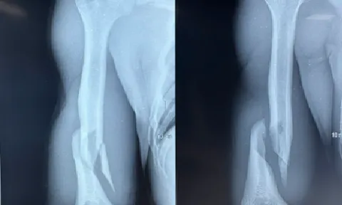 Thanh niên 19 tuổi gãy xương cánh tay vì vật tay