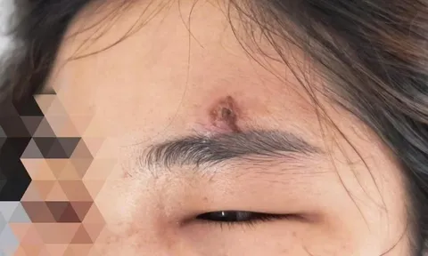 Hà Nội: Thiếu nữ 15 tuổi tử vong sau khi tự nặn mụn, bôi thuốc không rõ nguồn gốc