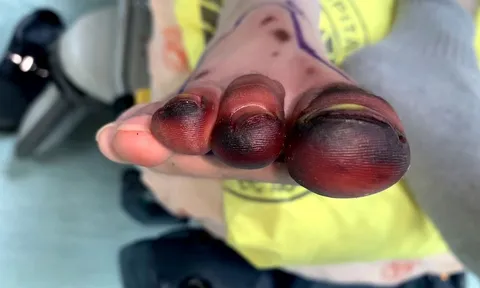 Sơ suất nhỏ khi đi du lịch, người phụ nữ phải đối mặt với nguy cơ mất chân