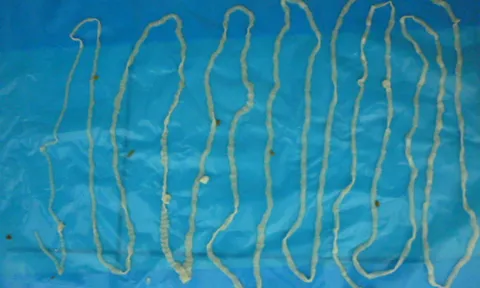 Tưởng rối loạn tiêu hóa, ai ngờ mang sán dây 3 mét "tru ngụ" trong bụng suốt năm trời