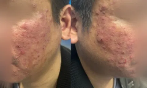 Da nổi mụn dai dẳng, người đàn ông sốc khi biết “thủ phạm” ẩn dưới da