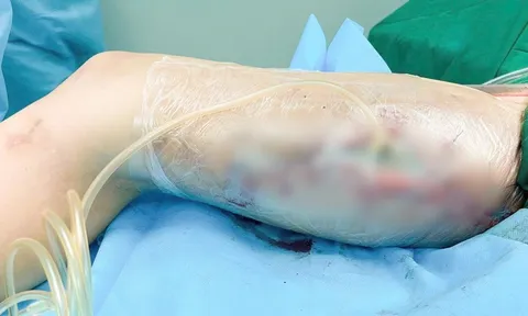 Ham làm đẹp cấp tốc bằng filler không rõ nguồn gốc, cô gái trẻ phải trải qua 60 ca mổ vì hoại tử đùi nặng