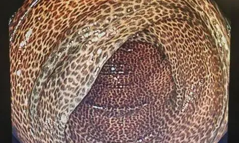 Ruột người đàn ông hóa đen như da rắn vì uống trà giảm cân suốt 2 năm