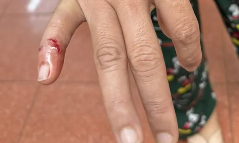 Bị chó lạ tấn công, một người ở Đắk Lắk tử vong vì chủ quan không tiêm phòng dại