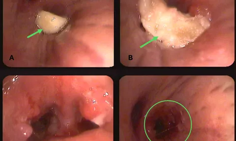 14 ngày ho không dứt, bác sĩ lấy ra thứ không ngờ từ phổi cụ ông 85 tuổi