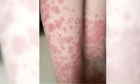 Nhuộm tóc liên tục, nữ sinh nhập viện vì thận “chảy máu”