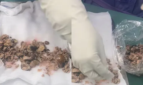 Bỏ qua dấu hiệu đau lưng, người phụ nữ mang trong người cả "bãi cát sỏi"