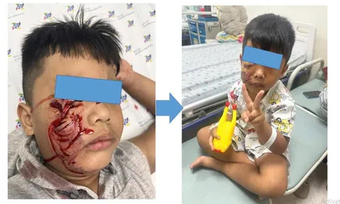 Bé trai 5 tuổi đang chơi trong sân nhà bất ngờ bị chó lao đến cắn rách mặt, phải khâu 20 mũi