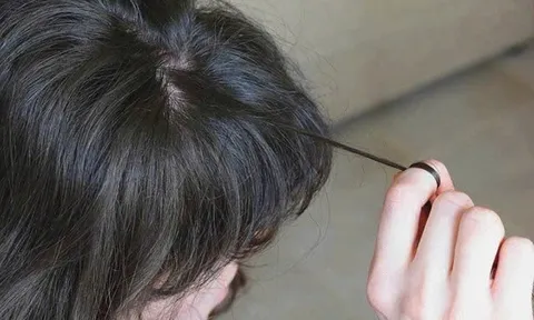 Nuốt tóc nhiều năm không biết, bé gái nhập viện với khối tóc dài hơn 20cm trong dạ dày