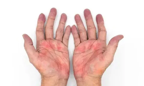 Sưng ở 5 chỗ này - dấu hiệu gan đang “kêu cứu” vì xơ hóa