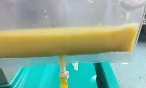 Máu trắng đục như sữa, nam bệnh nhân trẻ suýt mất mạng vì viêm tụy cấp