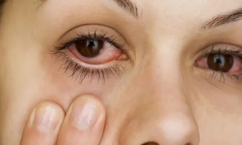 Đừng bỏ qua 5 dấu hiệu ở mắt có thể là lời kêu cứu từ thận