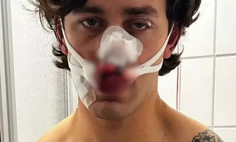 Mỹ nam 21 tuổi xông vào bảo vệ hai cô gái, khuôn mặt điển trai tan tành sau nhát dao trên tàu điện