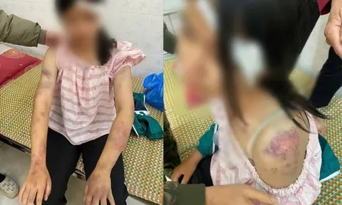 Bé gái 13 tuổi bị bà nội và hai người đàn ông đánh bầm dập: Xót xa hoàn cảnh quá éo le