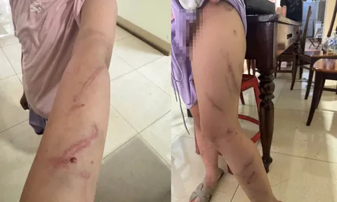 Bé gái 9 tuổi có 34 vết bầm trên cơ thể, nghi bị bạo hành: Công an vào cuộc làm rõ