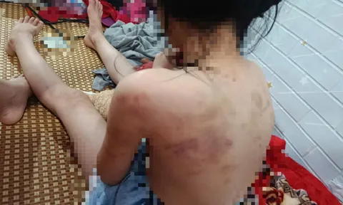 Hé lộ nguyên nhân vụ nữ sinh lớp 4 ở Cao Bằng bị nhóm bạn hành hung, cơ thể nhiều vết thâm tím