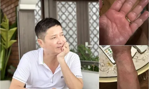 Điều bất ngờ về căn bệnh lạ khiến NSƯT Chí Trung ngứa ngáy khắp cơ thể, mất ngủ triền miên