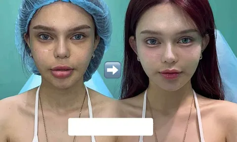 Nhan sắc tranh cãi của nữ tiktoker "nghiện thẩm mỹ", sau 15 lần "đập đi xây lại"