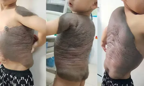 6 cuộc đại phẫu cứu bé trai mang "mai rùa" trên lưng suốt 7 năm