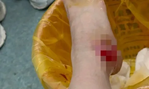 Clip: Cặp đôi mải hôn nhau, chàng trai ngã làm đổ nồi nước sôi vào người bên cạnh